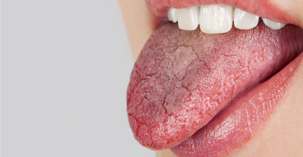 Xerostomia: Why You Shouldn't Ignore Dry Mouth